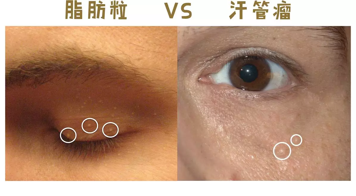 脂肪粒 vs 汗管瘤 粟丘疹(脂肪粒)一般是白色或淡黄色的,而汗管瘤颜色