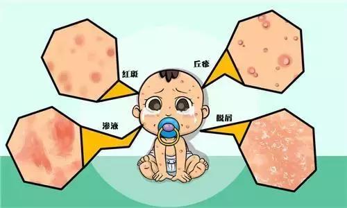 湿疹通常是婴儿出现的第一个过敏症状,其发病率在世界上许多国家呈现