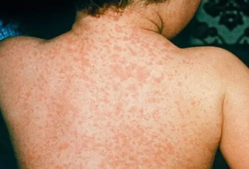 麻疹的初期症状类似于感冒,会伴随 发烧,流鼻涕,眼睛红肿,咳嗽等症状
