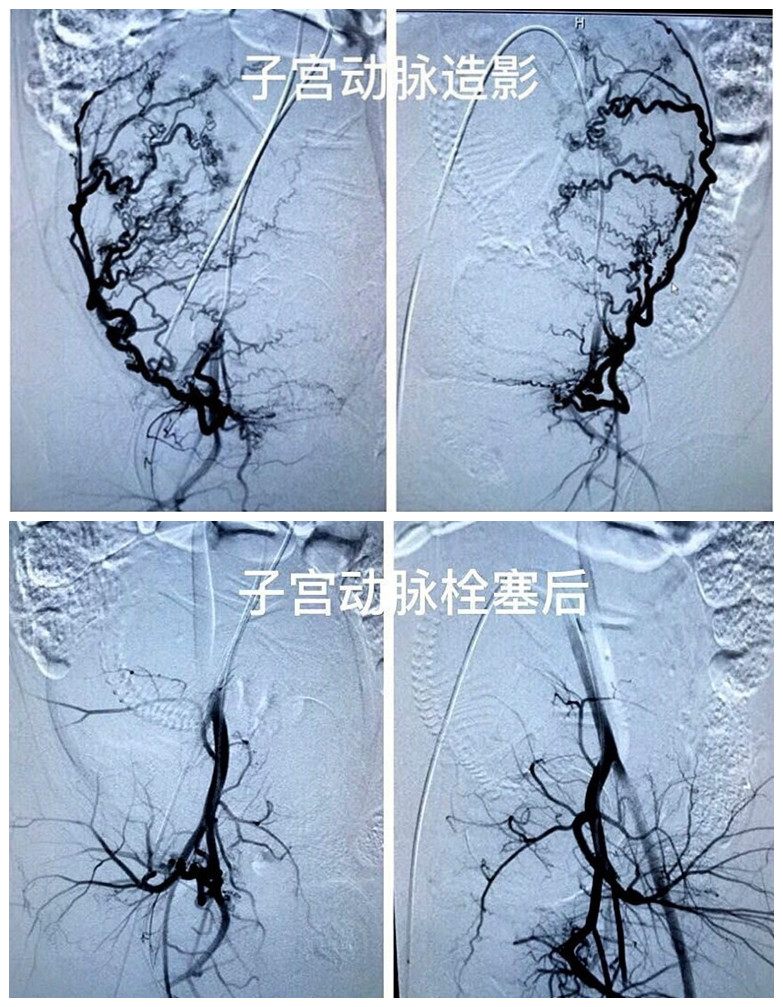 什么是子宫动脉栓塞术