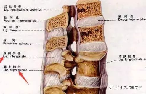 当脊柱突然屈伸时,极易造成棘上韧带从个别棘突上撕脱.