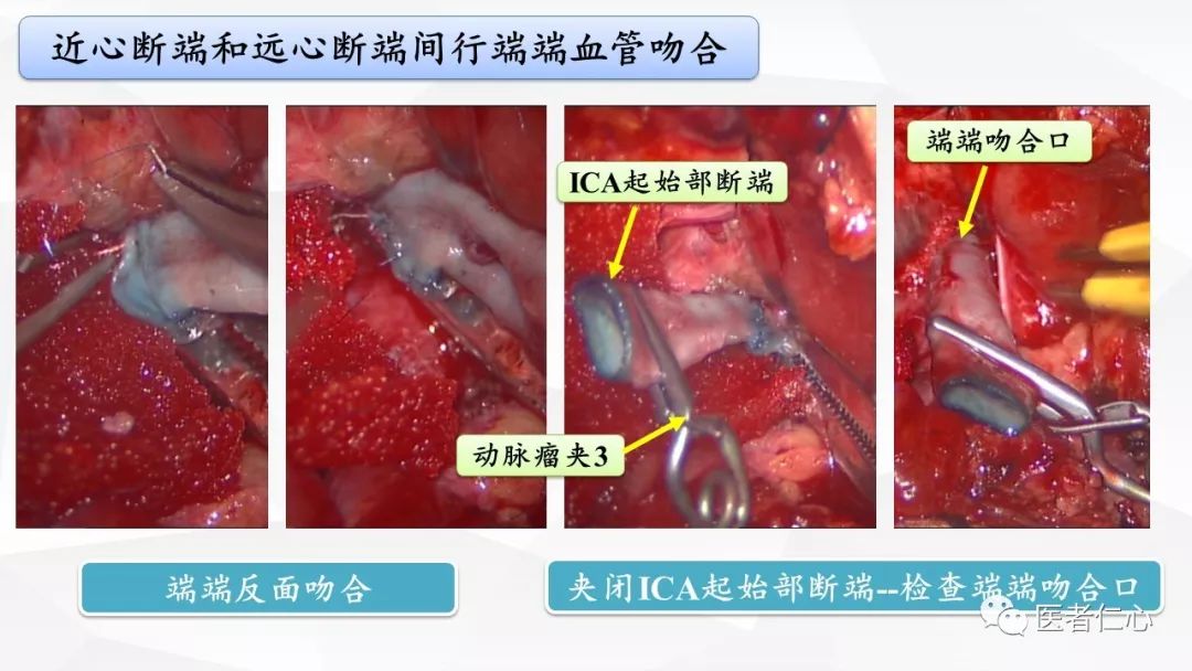 唐都医院张涛博士:左侧颈内动脉c1段串联巨大动脉瘤切除并血运重建术