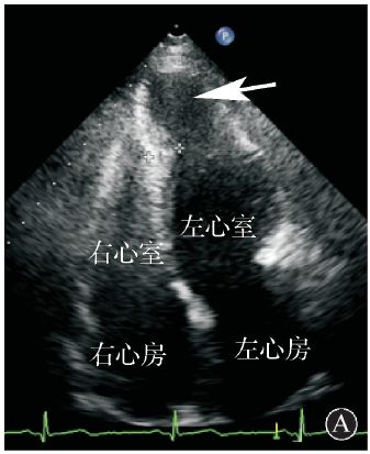超声心动图示心尖部室壁瘤约17 mm×21 mm,室壁瘤近端室间隔,左室前壁