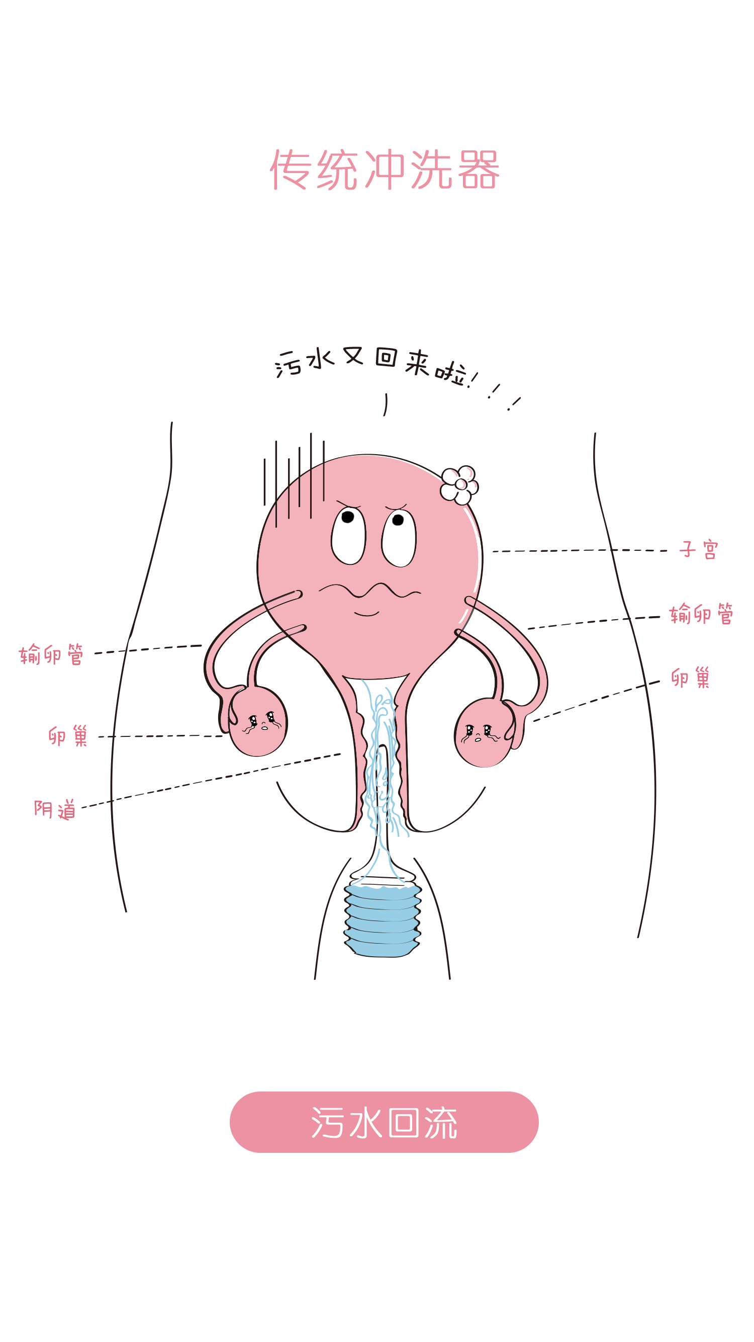 妇科冲洗器怎么用