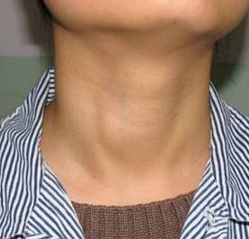 为什么很多人查出甲状腺结节,又查出乳腺结节呢?