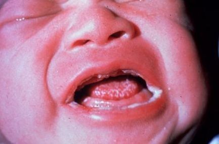 宝宝出现这5种舌苔颜色可能是抵抗力过差