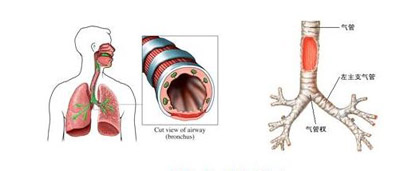 专家讲解支气管炎的症状诱因与治疗方法