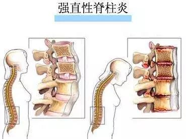 强直性脊柱炎6个地方疼，强直性脊柱炎6个地方疼图后背的前身图