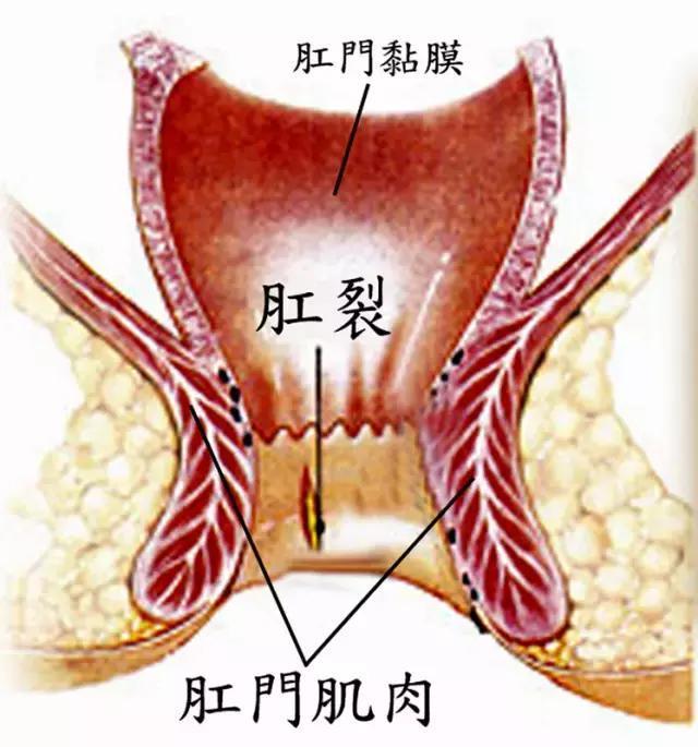 肛裂和痔疮的症状都有哪些?我分不清自己患的是肛裂还是痔疮?