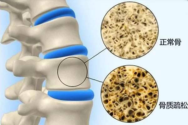关节炎骨质疏松骨质增生骨折等骨病的病理分析及解决方法