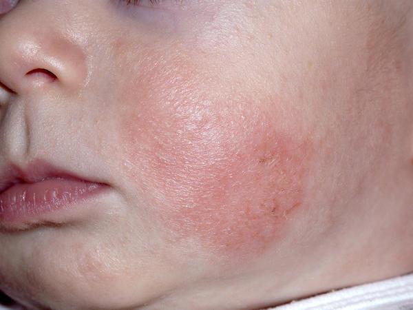 分辨宝宝湿疹口水疹尿布疹儿童皮疹及各种皮肤状况的特征附照片慎入