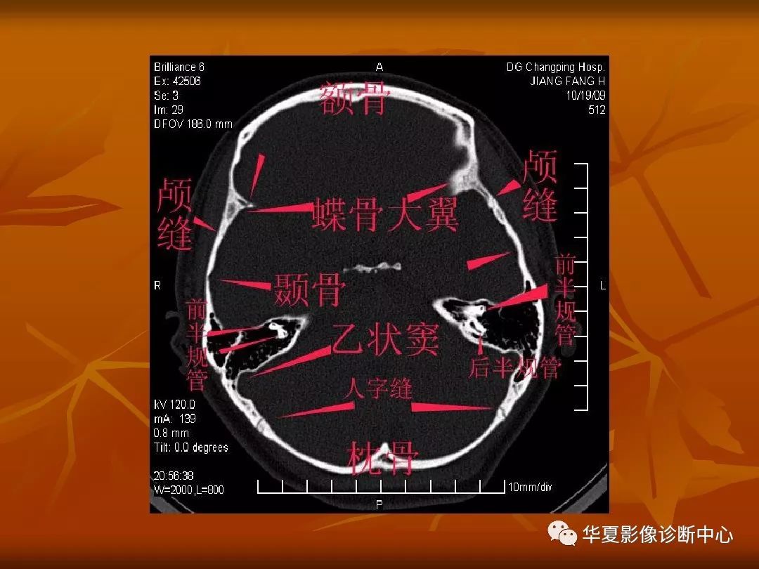 最全的颅骨ct解剖及外伤骨折的诊断