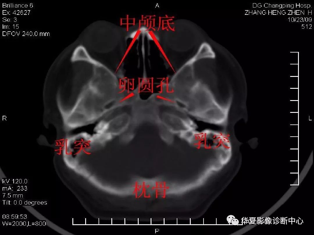 最全的颅骨ct解剖及外伤骨折的诊断