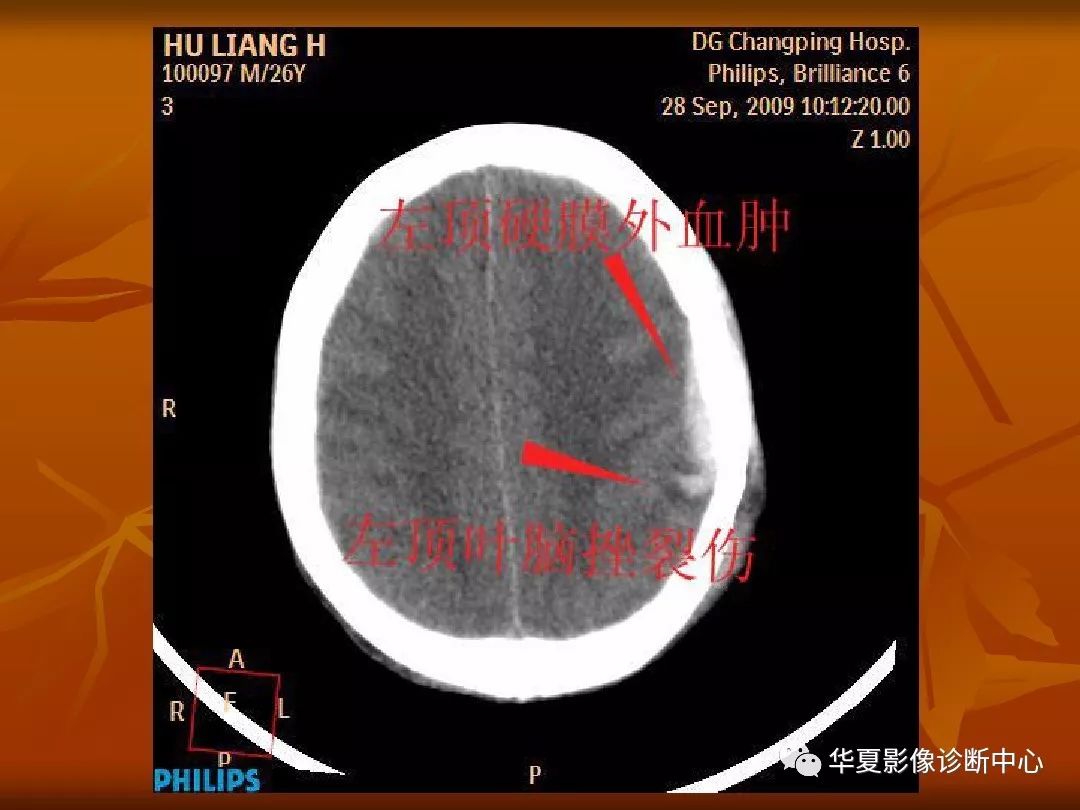 最全的颅骨ct解剖及外伤骨折的诊断