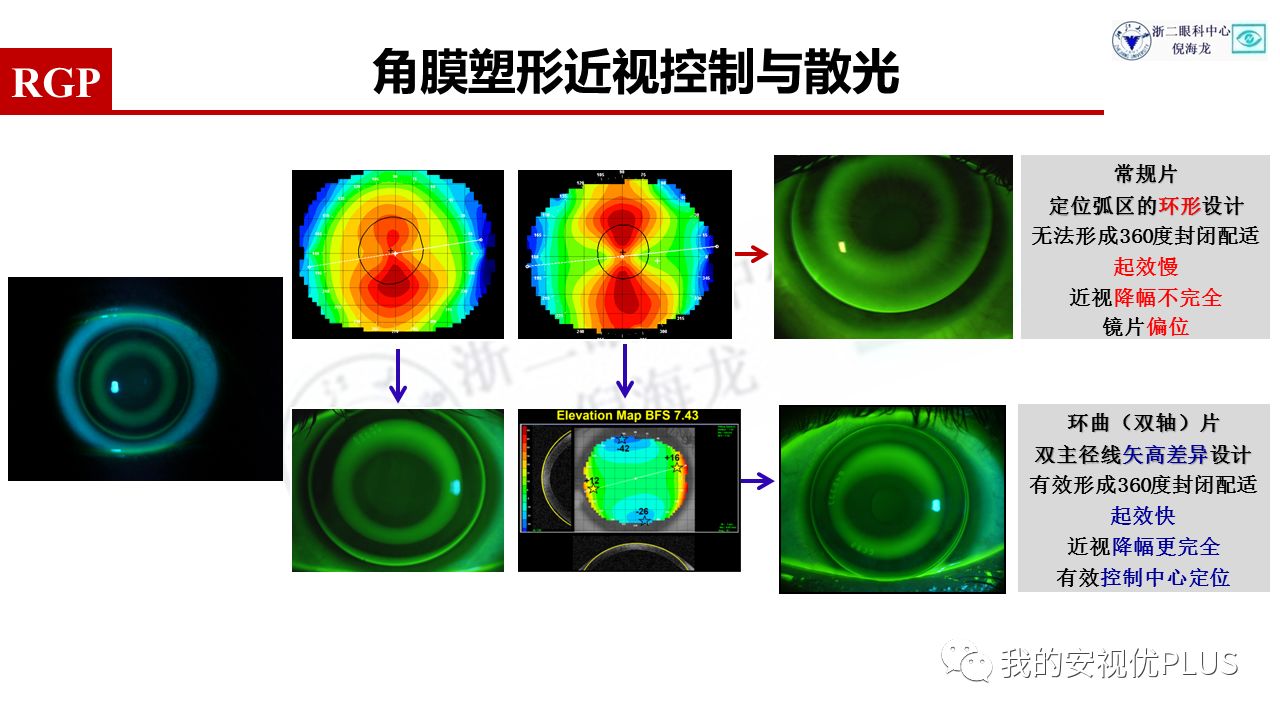 角膜前表面不同象限存在高度差的)近视控制角膜塑形领域