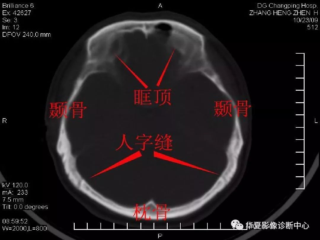 最全的颅骨ct解剖及外伤骨折的诊断