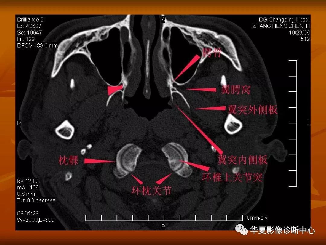 最全的颅骨ct解剖及外伤骨折的诊断