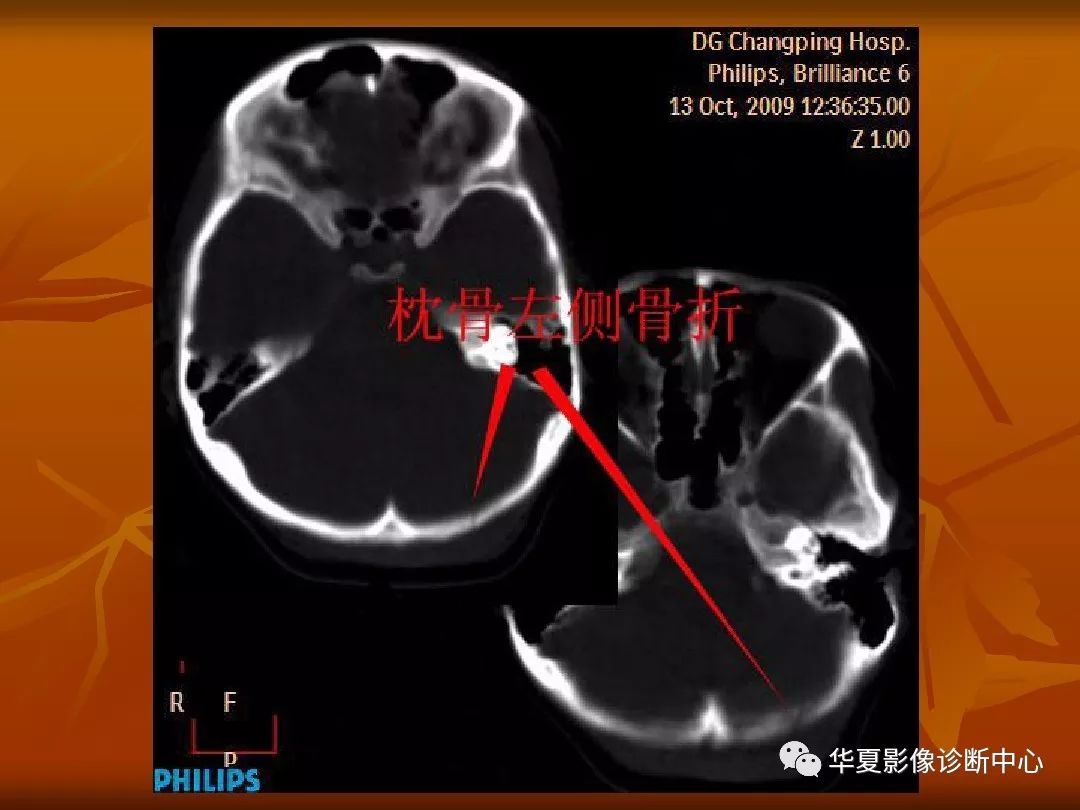 最全的颅骨ct解剖及外伤骨折的诊断