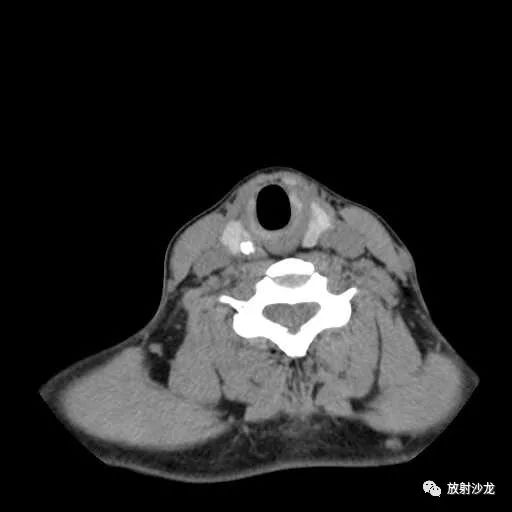 黑色不规则部分为钙化,水平线以上示良性钙化周围纤维化内部无瘤巢