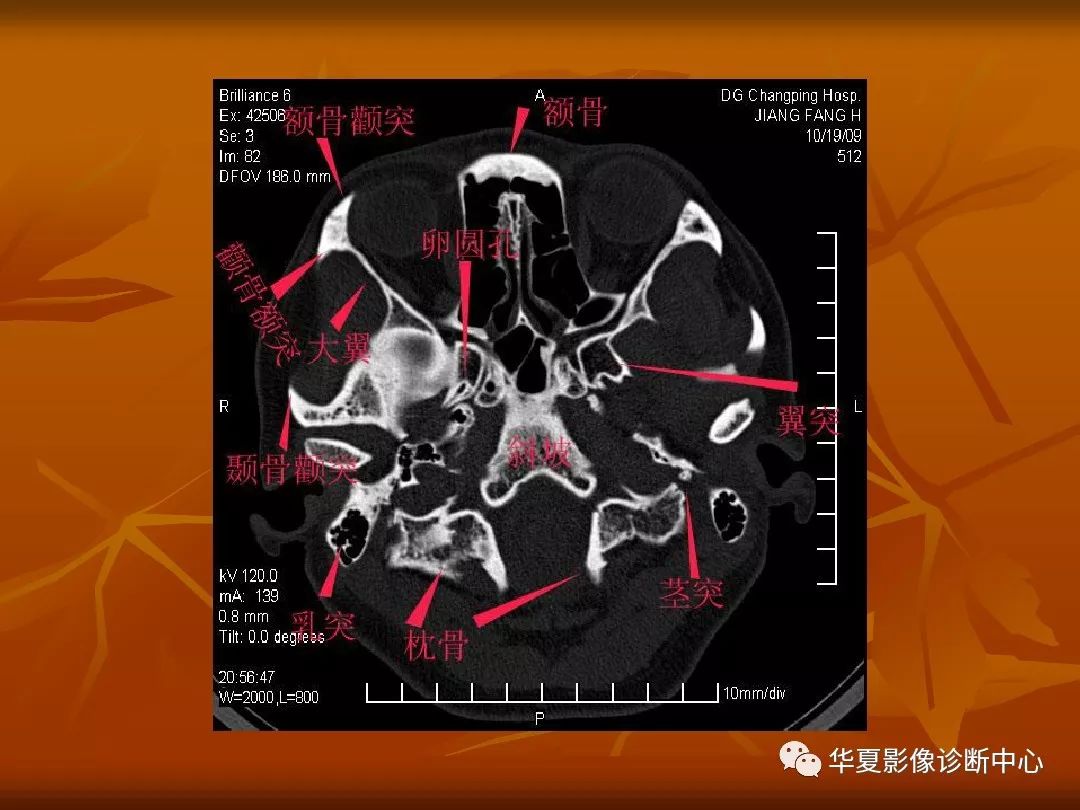 最全的颅骨ct解剖及外伤骨折的诊断