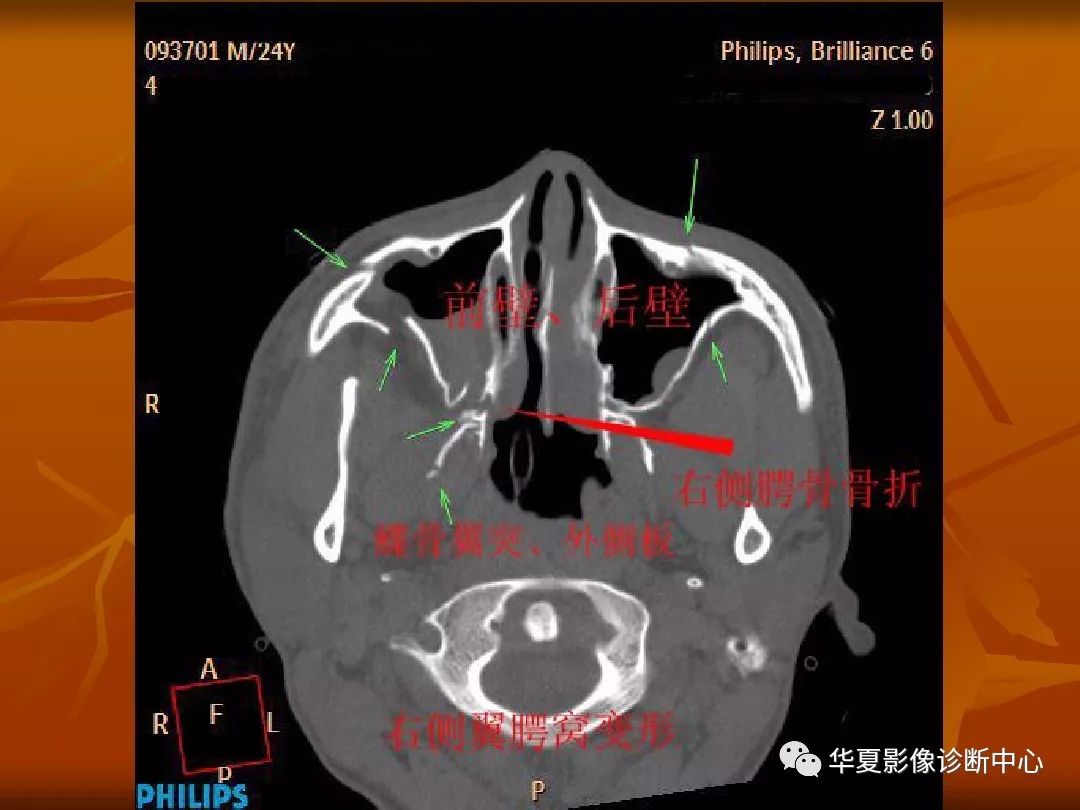 最全的颅骨ct解剖及外伤骨折的诊断