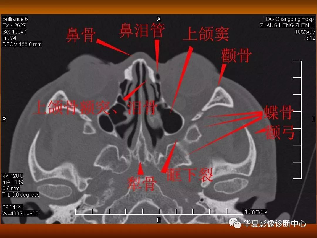 最全的颅骨ct解剖及外伤骨折的诊断