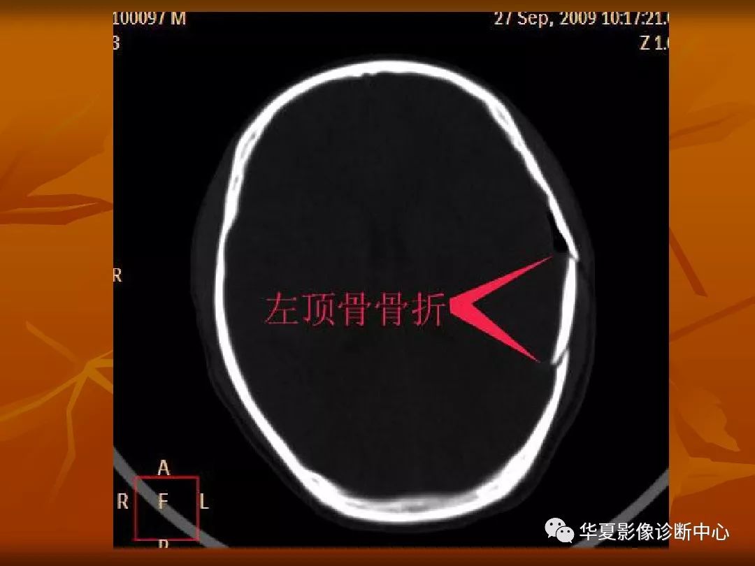 最全的颅骨ct解剖及外伤骨折的诊断