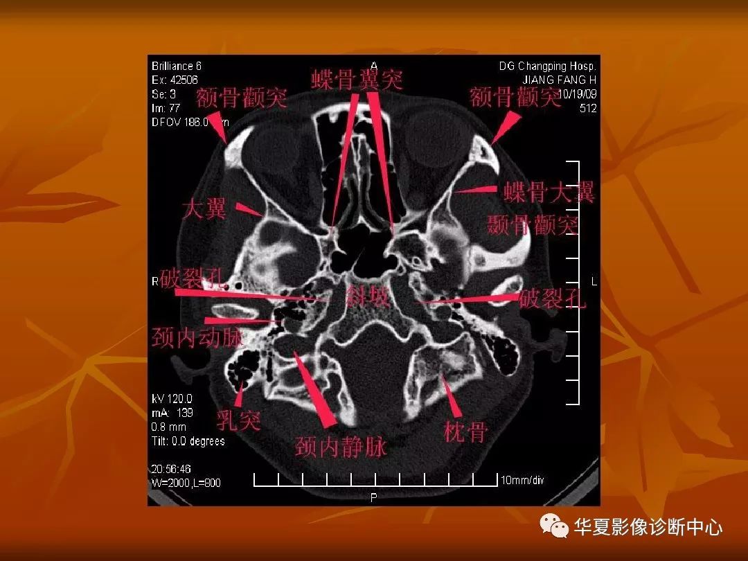 最全的颅骨ct解剖及外伤骨折的诊断