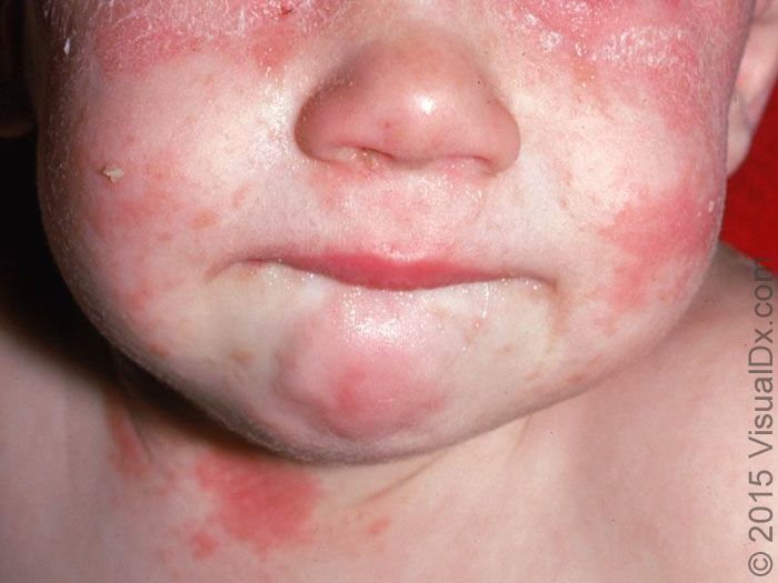 皮科新观察丨婴儿脂溢性皮炎的治疗