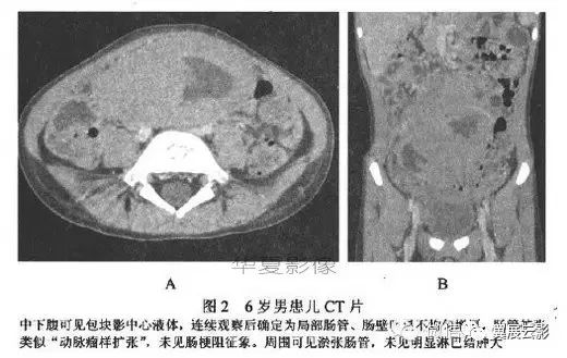 儿童恶性淋巴瘤ct表现