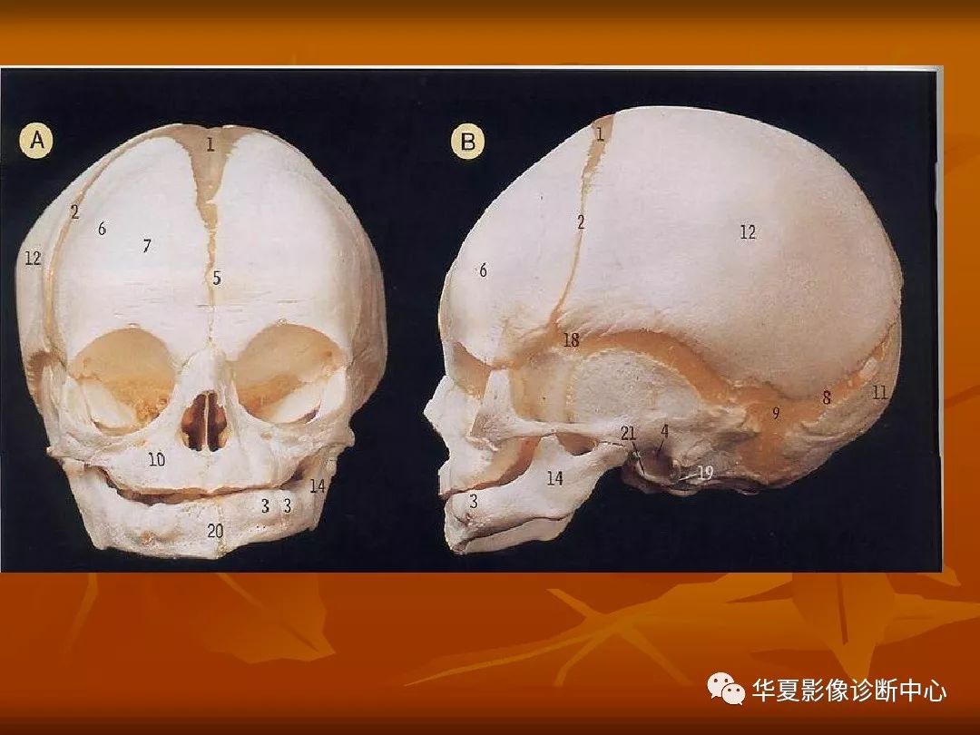 最全的颅骨ct解剖及外伤骨折的诊断