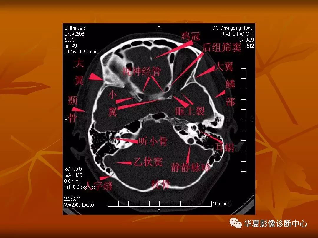 最全的颅骨ct解剖及外伤骨折的诊断