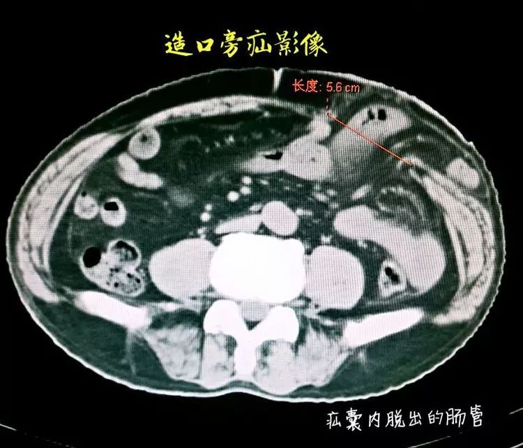 【普外二科】造口旁疝的治疗