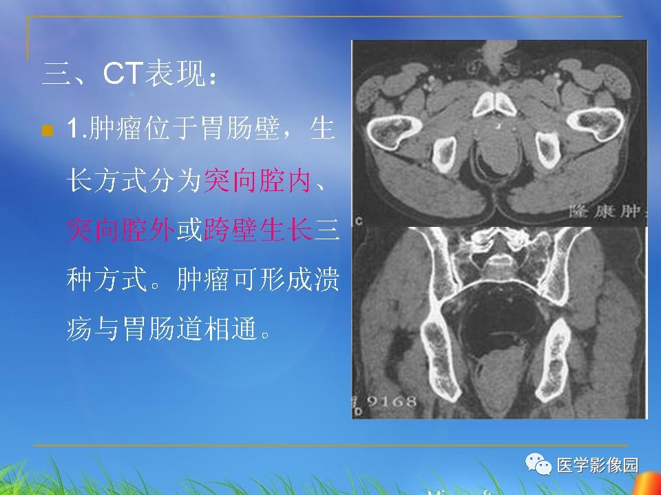 结肠常见恶性肿瘤的ct诊断丨影像天地