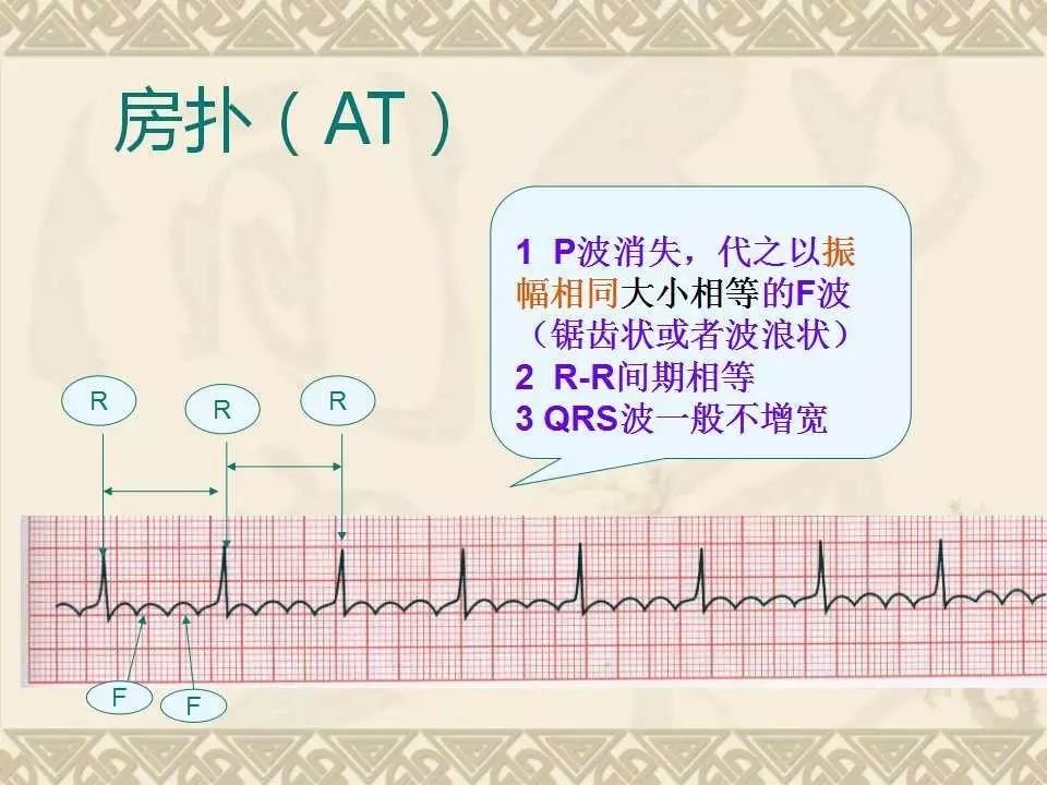 护理人员常见异常心电图的识别
