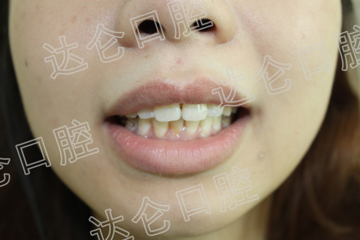 【真实案例】牙齿中线不齐导致嘴歪 如何通过牙齿矫正