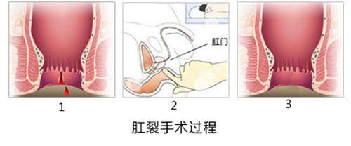 不是,肛裂反覆发作,会在外口处形成一个皮肤赘生物,称之巧哨痔.