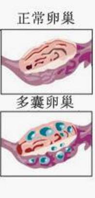 在腹腔镜下对多囊卵巢应用电针或激光打孔,每侧卵巢打孔4个为宜,并且