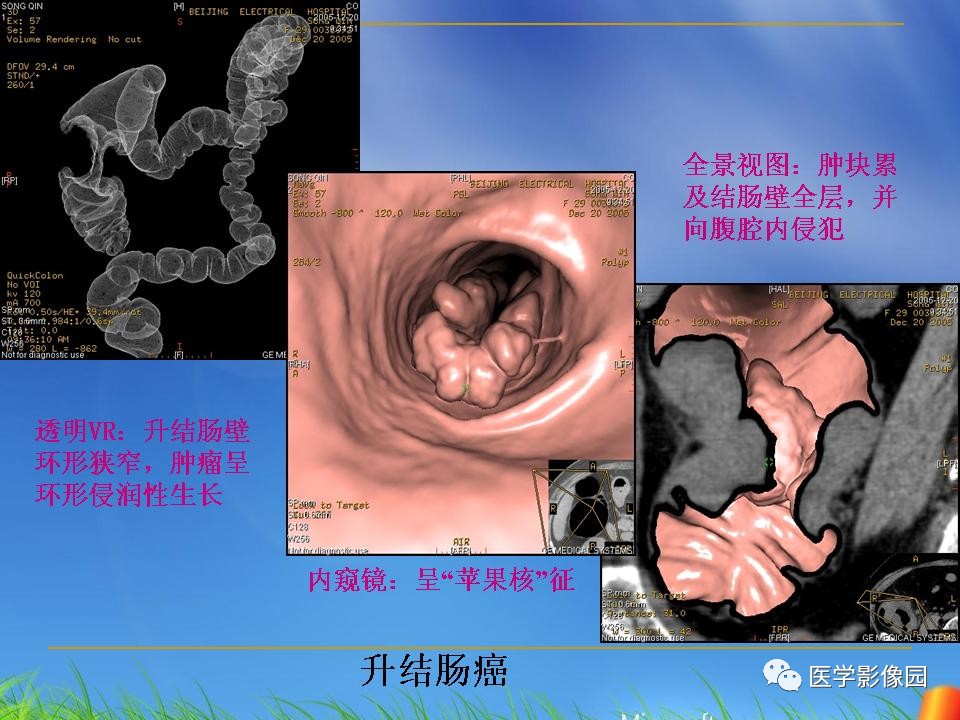 结肠常见恶性肿瘤的ct诊断丨影像天地