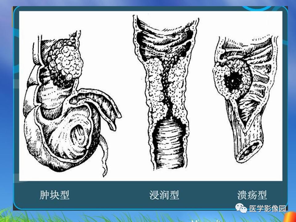 结肠常见恶性肿瘤的ct诊断丨影像天地