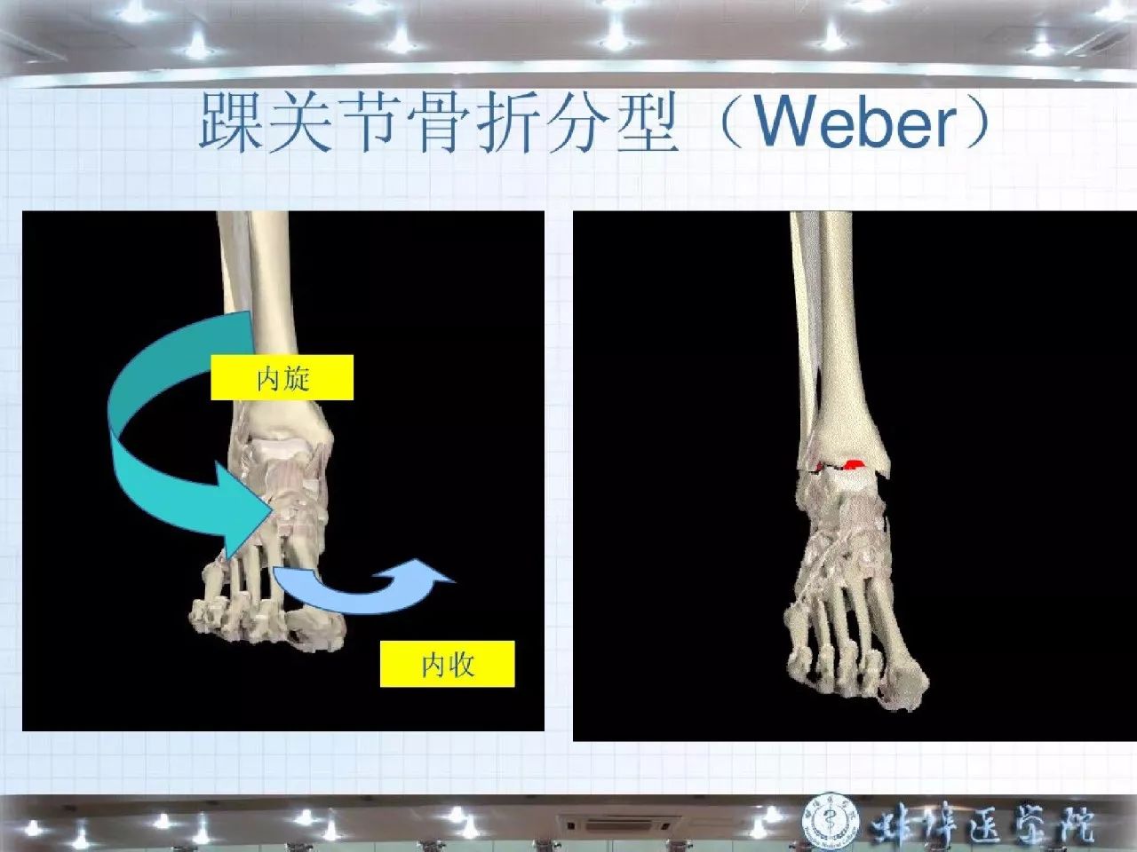 踝骨骨折护理查房