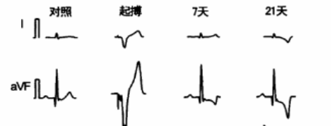 有趣的心电图 | 许静教授:t波记忆那些事