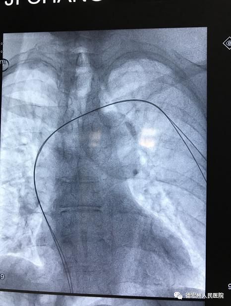 腋静脉穿刺成功