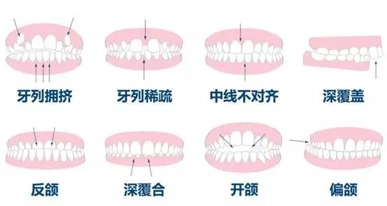 做牙齿正畸就是用生理范围的力将错位的牙齿排列整齐.