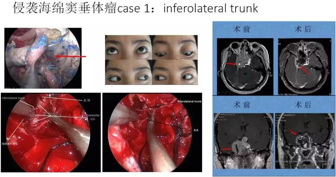 看点三:侵袭海绵窦垂体瘤的切除技巧