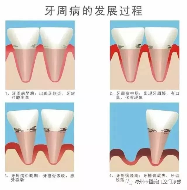 如果不及时治疗,炎症会进一步发展,引起深部的牙槽骨吸收,发展成牙周