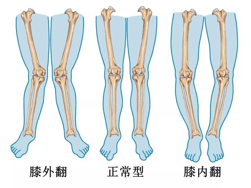 通过膝关节的力要避免聚集在膝关节内侧或者外侧