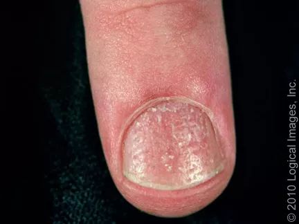 湿疹 患湿疹时也可出现指甲上有小凹陷的情况,这是由于 皮肤和指甲