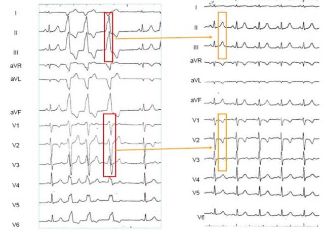 有趣的心电图 | 许静教授:t波记忆那些事