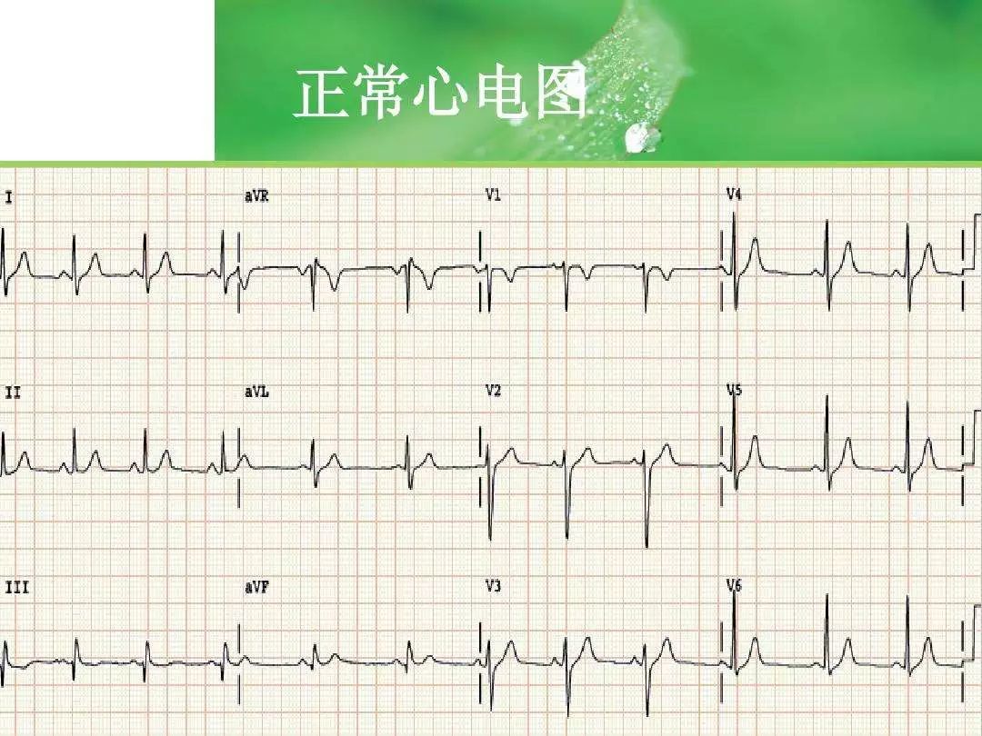 心电图常见正常和异常心电图图谱_word文档在线阅读与下载_文档网